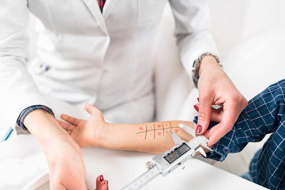 allergicreactiontest (1)